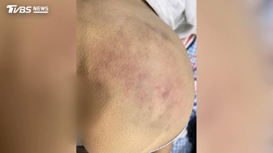 補英文卻被數學師抓去打!男童「屁股瘀青一片」家長淚崩提告。(圖/TVBS)