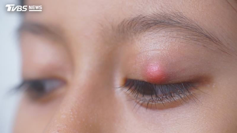 許多人認為,「長針眼」的最大主因,與「衛生習慣不佳」有關。(示意圖/shutterstock達志影像)