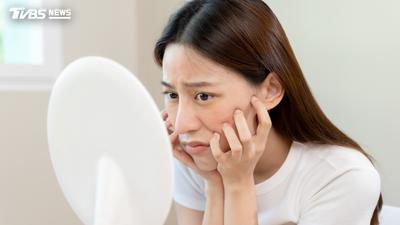額頭、下巴狂冒痘有原因?中醫揭「4部位」線索 2生活習慣要調整
