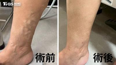 台中婦冒青筋拖30年!右腿凹凸不平 醫:血栓風險高5.3倍