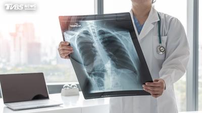 「菜瓜布肺」有救了!中醫大附醫突破性研究逆轉肺纖維化