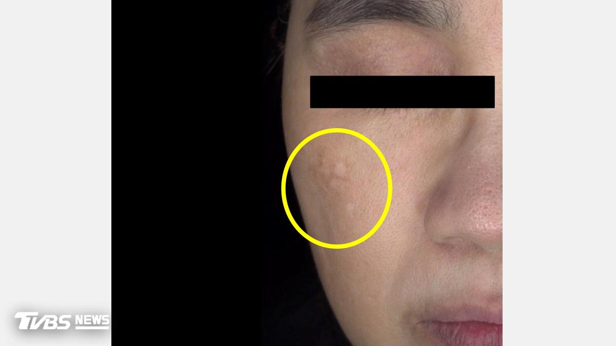 每月打皮秒雷射竟變「花花臉」 醫建議:「先醫再美」避免傷害皮膚