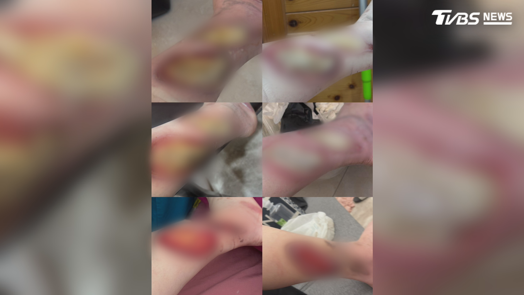 A小姐因車禍導致腳部三級燒燙傷,行走都有困難,卻仍被強行要求上工表演(圖/TVBS)