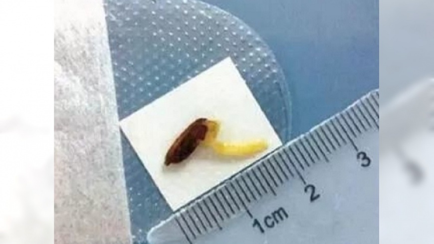 眼睛發芽了?稻穀噴進眼睛 婦人爆痛2個月險失明