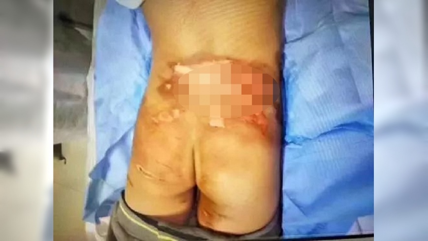 小3生遭開水燙下體霸凌　校長竟稱：鬧著玩