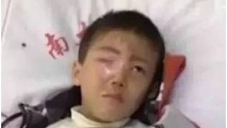乾燥劑遇水爆炸 　陸男童眼球遭溶永久失明