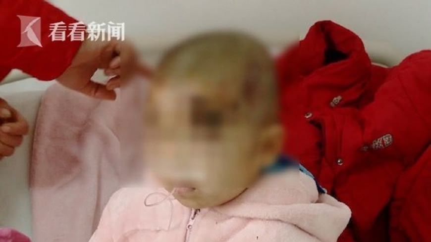 挺身保護2歲妹 5歲哥遭藏獒狂咬縫38針