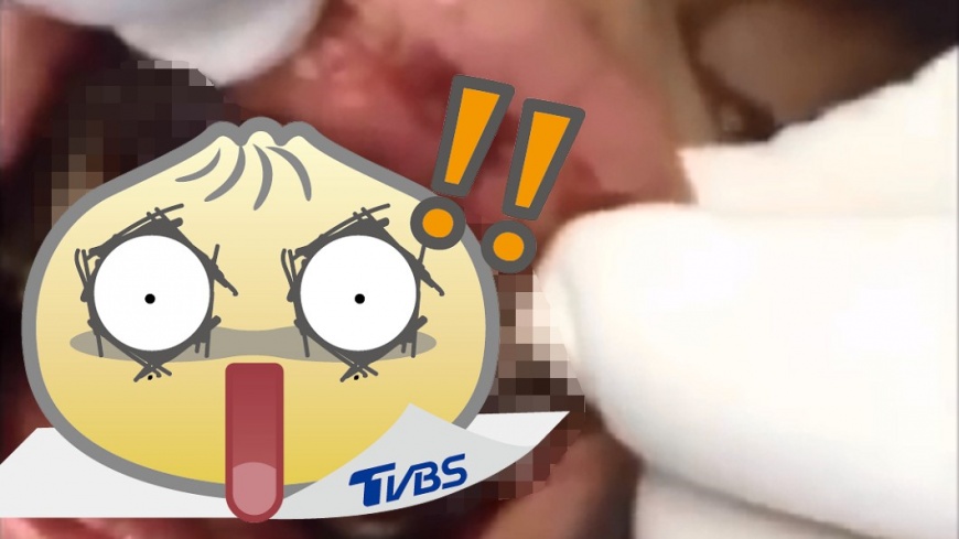 噁爆!男張嘴「牙齦都活蛆」 幼蟲在黑牙間亂竄