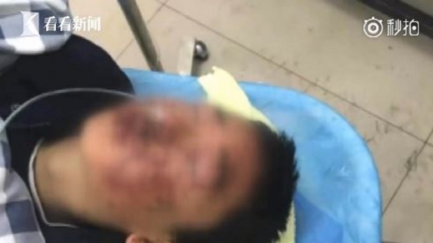 聽MP3竟爆炸!85元買劣質品 陸男險失明