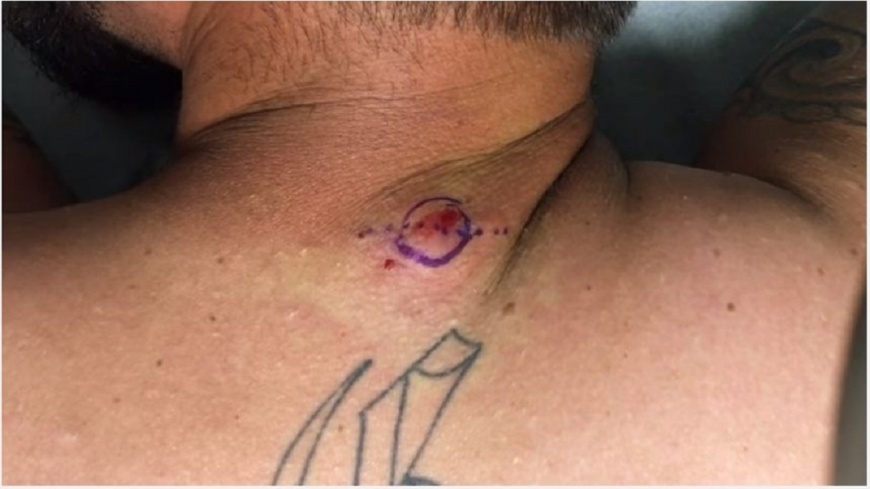 慎入!男背長「乳頭囊腫」 手術刀一劃流出噁臭黃奶油