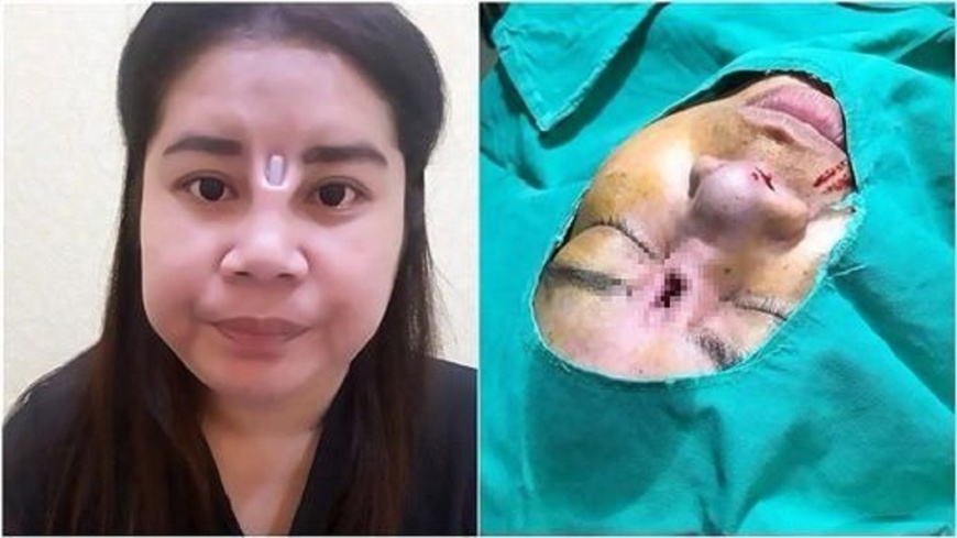 驚!女隆鼻感染發炎 「填充物」竟穿破皮膚