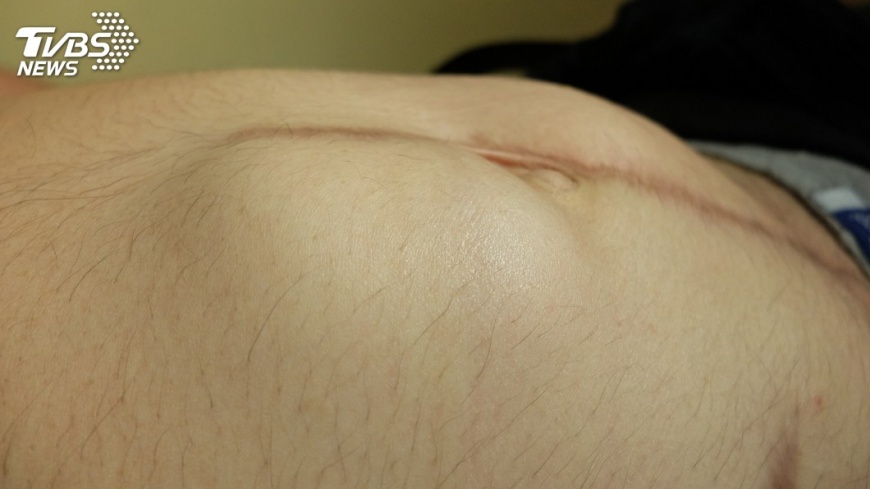 女性腹股溝疝氣不留疤　長庚首創新療法