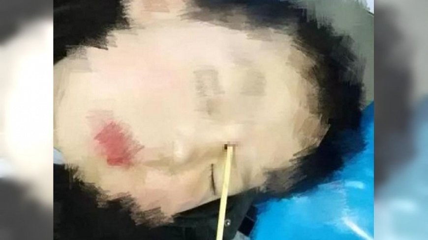 痛啊!童拿關東煮竹籤玩耍 跌倒插入眼眶