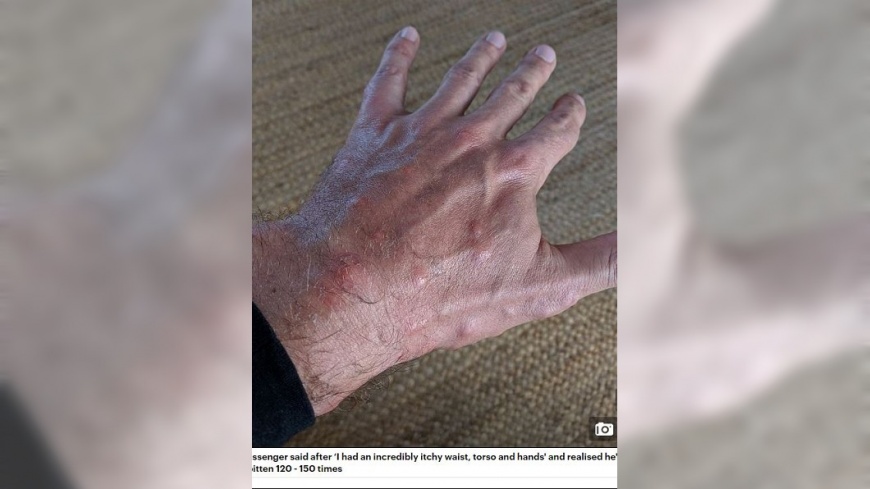 男子的手全是被叮咬出現紅腫的痕跡,他當場超崩潰。(圖/翻攝自每日郵報)