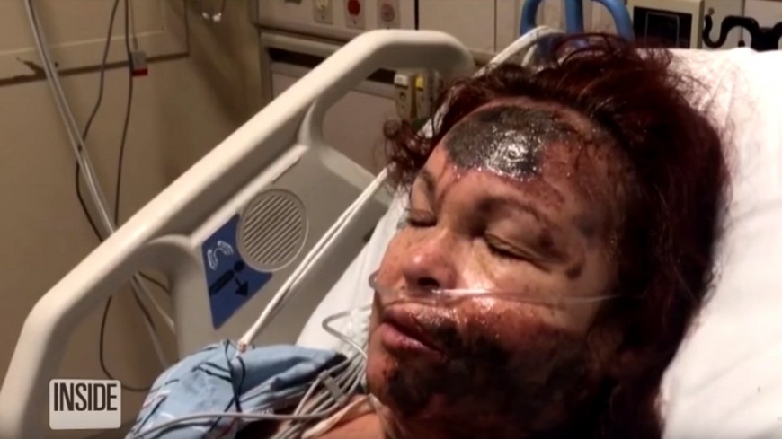 臉融化了!婦稱遭路人潑酸 警戳破真相是…
