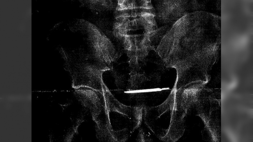 驚悚!老兵腹痛4年 驚見13公分手術刀藏肚內