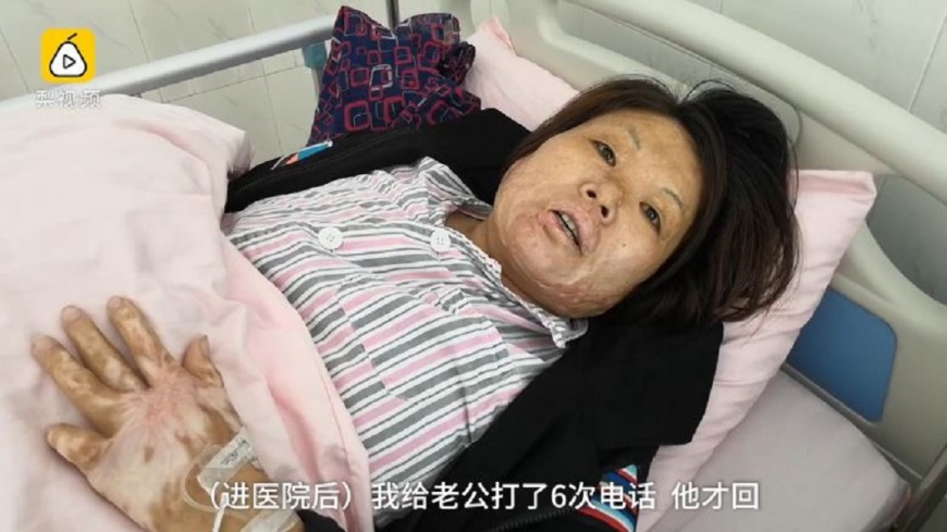 婦燒傷毀容！夫半天休妻：啥鬼樣　她心痛簽字遇真愛