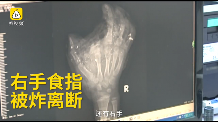 手機充電爆炸 男童食指炸斷右眼失明