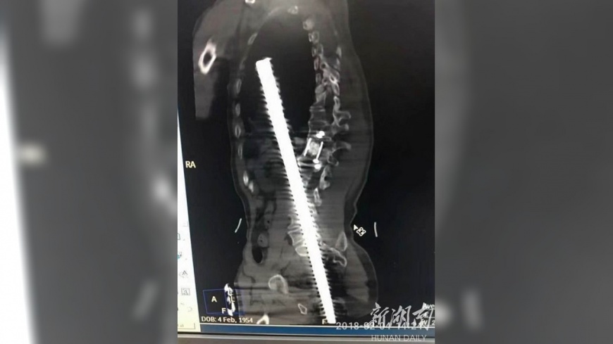 工人從2公尺高摔落 鋼筋從肛門插入胸腔