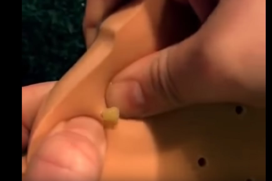 圖/翻攝YouTube Blackheads Removal。