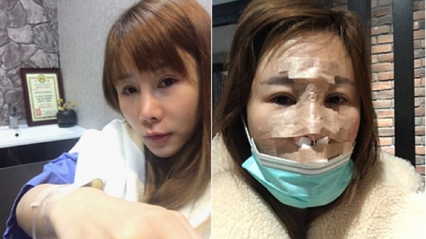 捧腫臉逃難！港星來台整型遇強震　嚇哭「怕毀容」