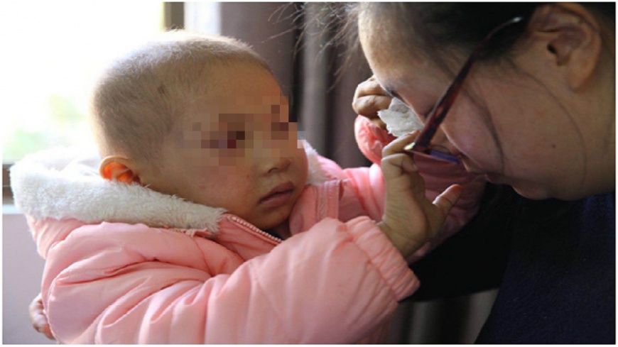 3歲女童右眼長瘤害失明 怕母傷心騙她「還看得見」