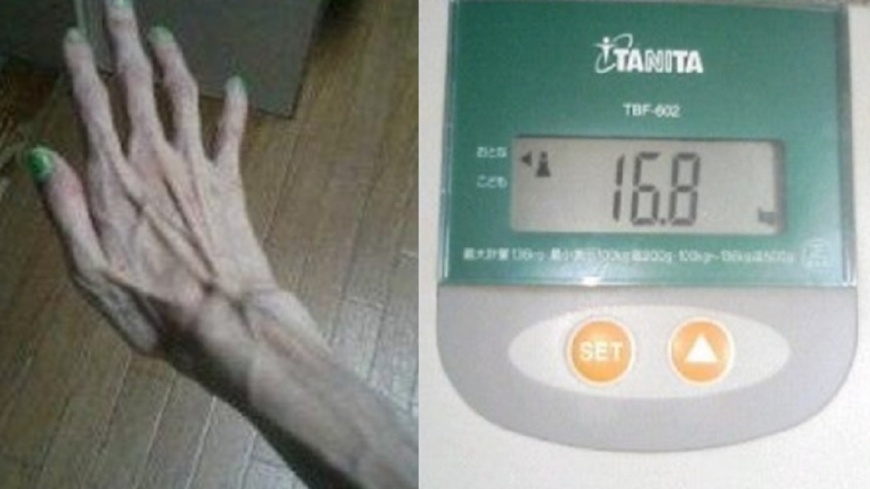 她自曝遭祖父虐待成「骷顱」　瘦到只剩16KG