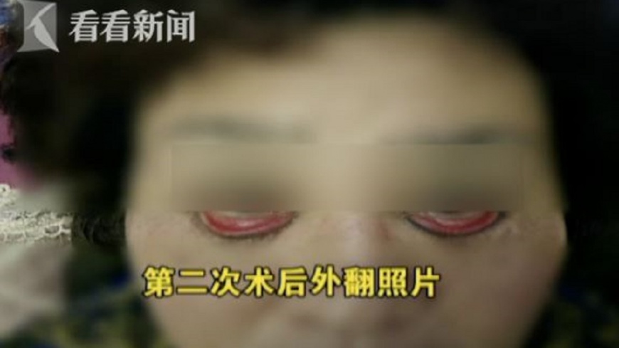 整形慘成眼瞼外翻!大媽眼淚狂噴 只能「睜眼睡覺」