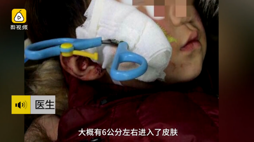 2歲童玩剪刀摔倒 刀刃3公分直插頭顱