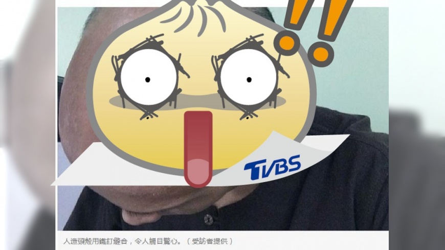男出車禍削掉半顆腦袋　醫植入50根鐵釘縫合