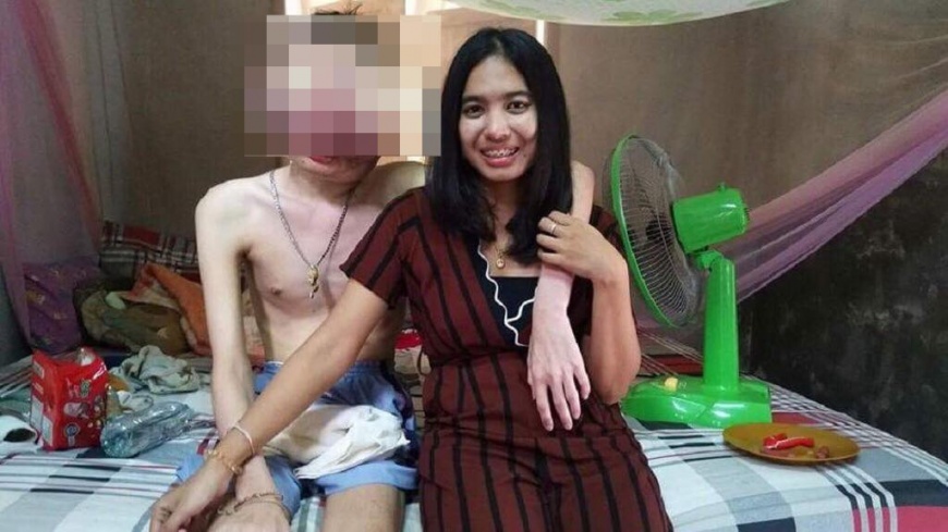 男友染怪病眼凸臉變形 女陪伴3年不離棄