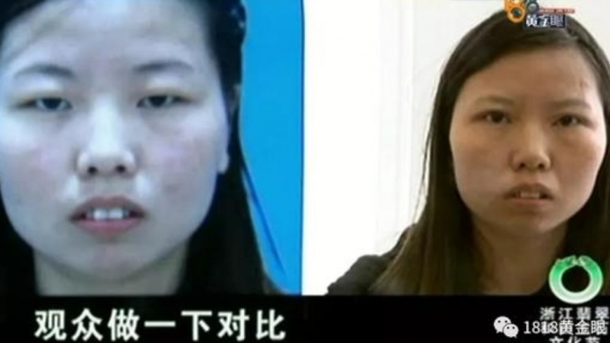 花15萬割雙眼皮「根本沒差」 怒拒付款爆糾紛