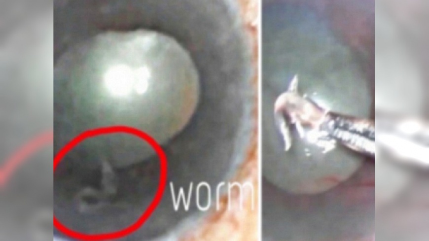 醫生從婦人鼻子取出這條1公分的寄生蟲。圖/翻攝自《頭條日報》