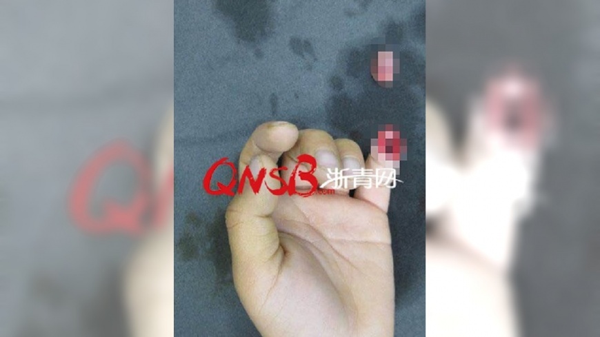 驚!男童調皮把玩腰帶 竟扯斷小指一節