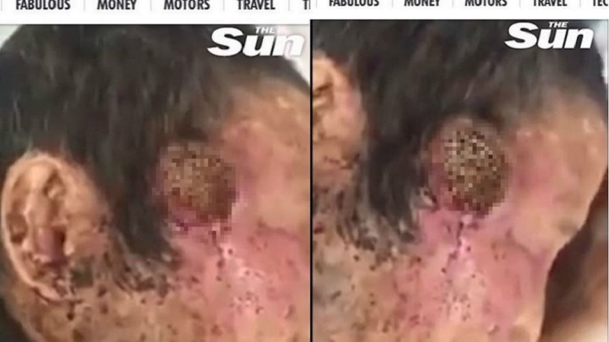 慎入！男子頭部萬蟲攢動　太陽穴被啃出大洞