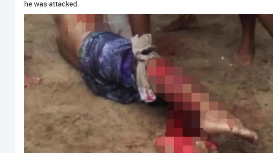 男游泳遭鯊魚攻擊!撕咬右腿血肉模糊可見骨