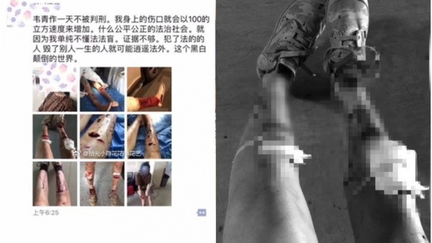 女子原先在網路上控訴自己遭韋姓留學生下藥性侵,還附上多張傷痕照 圖/取自微博