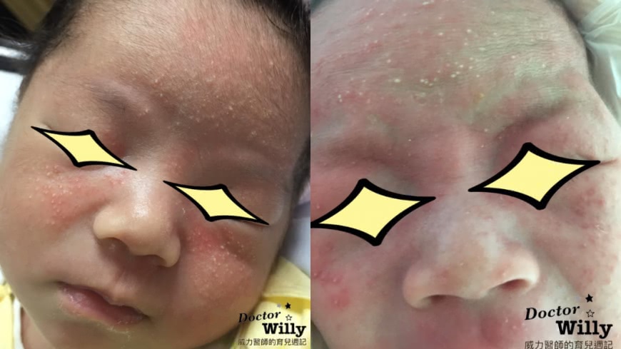 醫師說若嬰兒臉上出現「青春痘」，只需用溫水清潔即可。圖／翻攝自「威力醫師的育兒週記－王韋力」