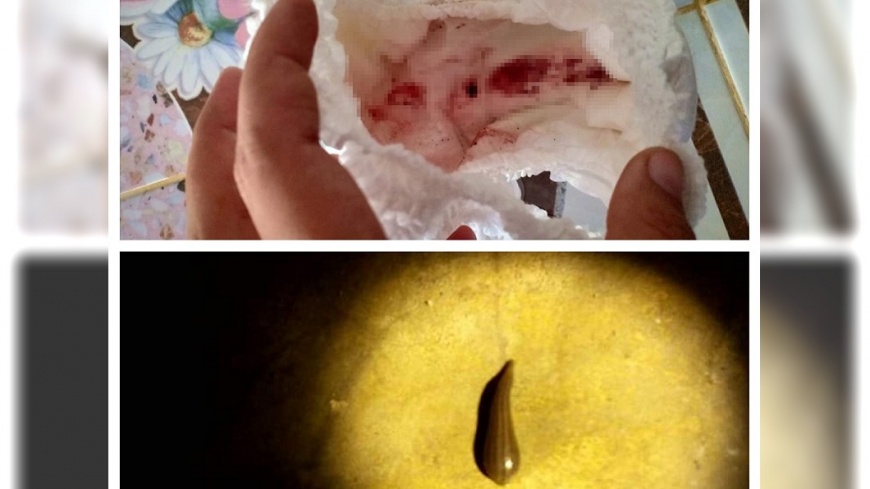 驚!女童噴血爆哭 原來是牠「吃到飽」