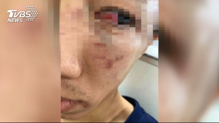 國五上被攔車　駕駛遭爆打眼睛出血全身傷