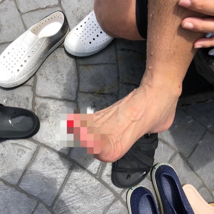吳宗憲右腳流血。(圖/翻攝自吳宗憲臉書)