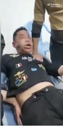 男子被蛇咬傷,臉腫成豬頭。(圖/翻攝自微博)