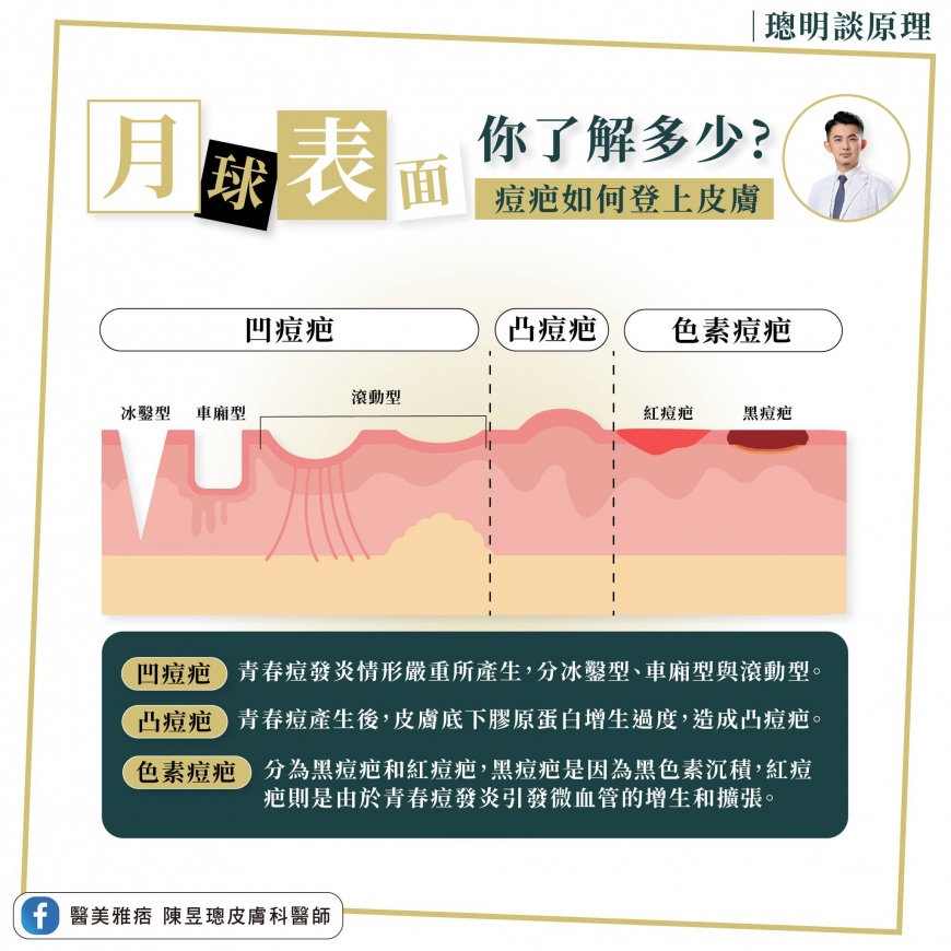 痘疤種類示意圖。(圖/翻攝自醫美雅痞 陳昱璁皮膚科醫師臉書)