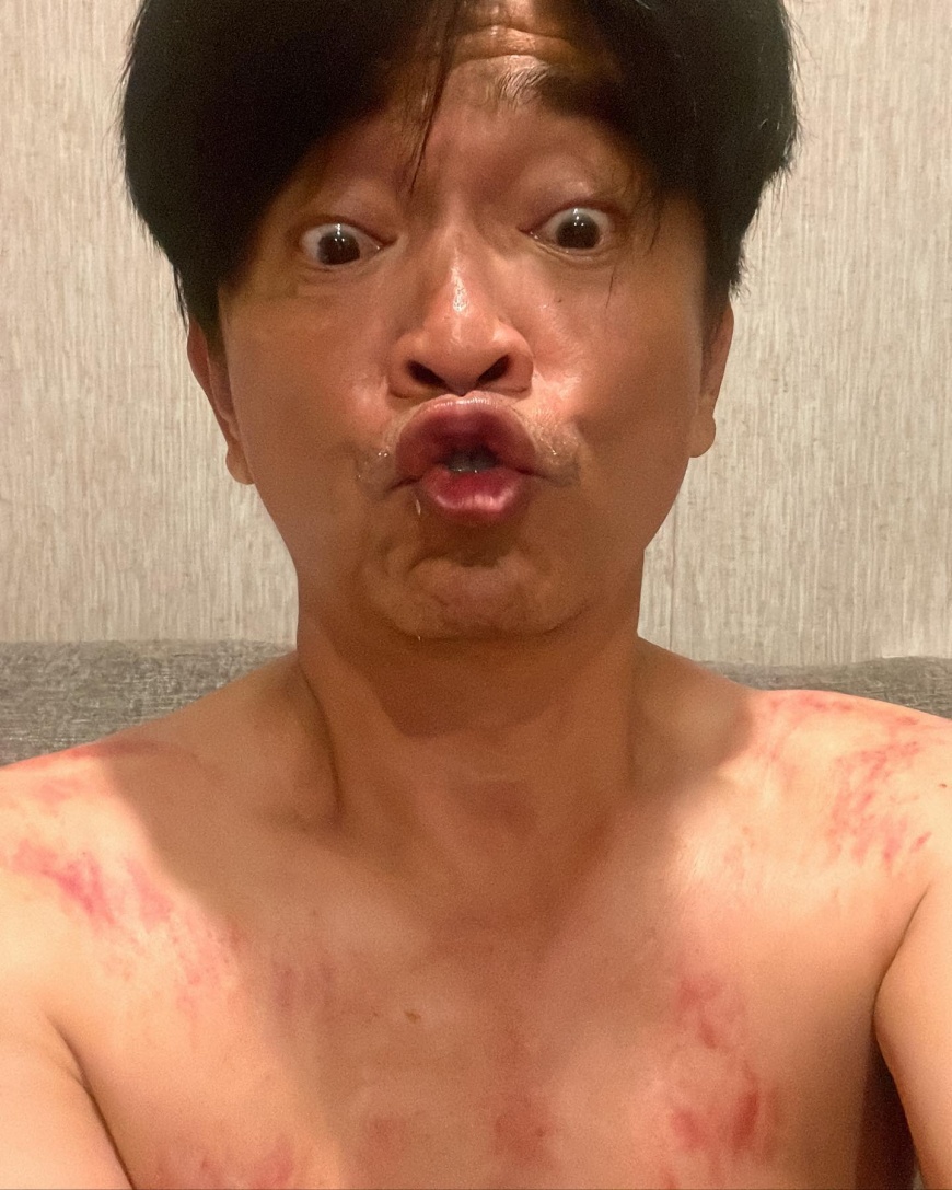 吳宗憲刮痧。(圖/翻攝自吳宗憲臉書)