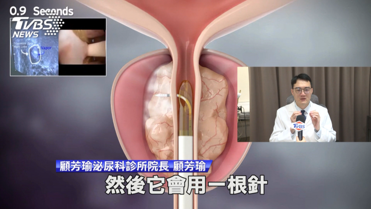 水蒸氣消融是以推送熱蒸氣到達組織,去傷害攝護腺肥大的細胞。