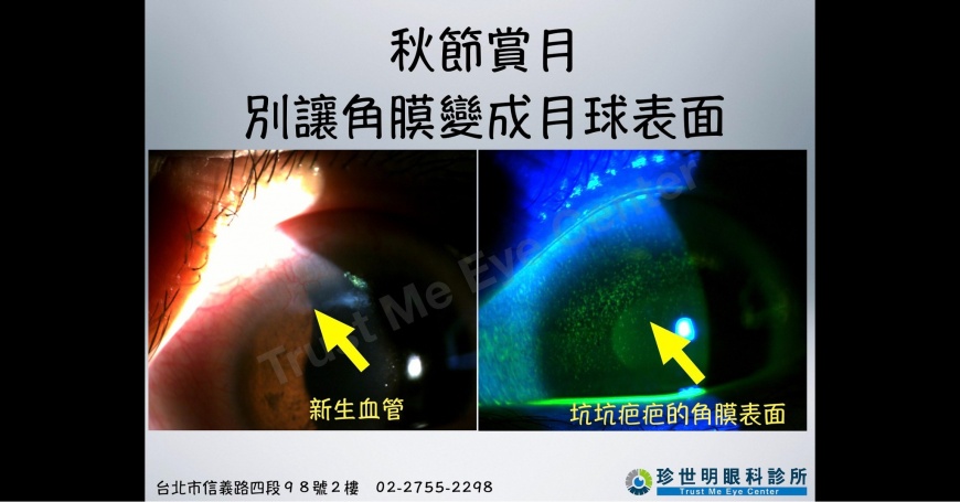 一名女性因在中秋節長期配戴美瞳片，導致角膜被磨損到猶如月球表面。（圖／翻攝自「王孟祺醫師-眼科最前線」臉書）