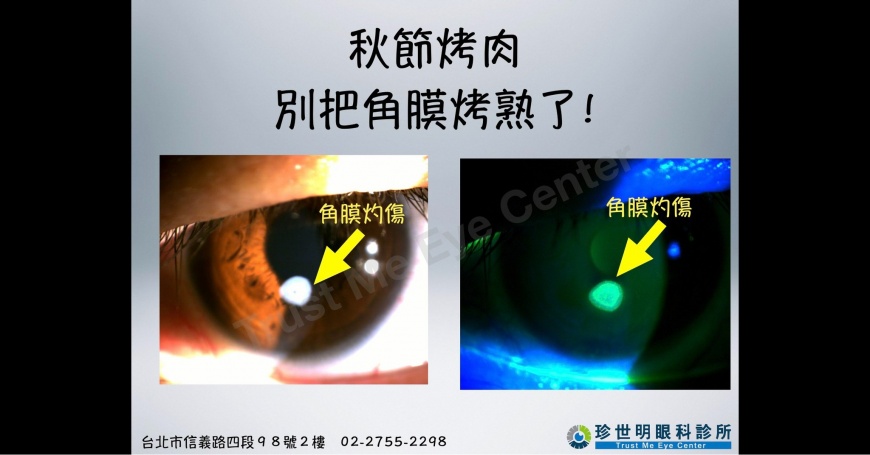 一名病患被木炭遇火燃燒產生的碎片擊中眼睛，角膜瞬間被烤熟。（圖／翻攝自「王孟祺醫師-眼科最前線」臉書）