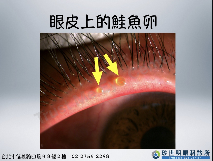 醫師檢查後發現，女子眼皮上的鮭魚卵其實是瞼板腺分泌出來的異常油脂。（圖／翻攝自「王孟祺醫師-眼科最前線」臉書）