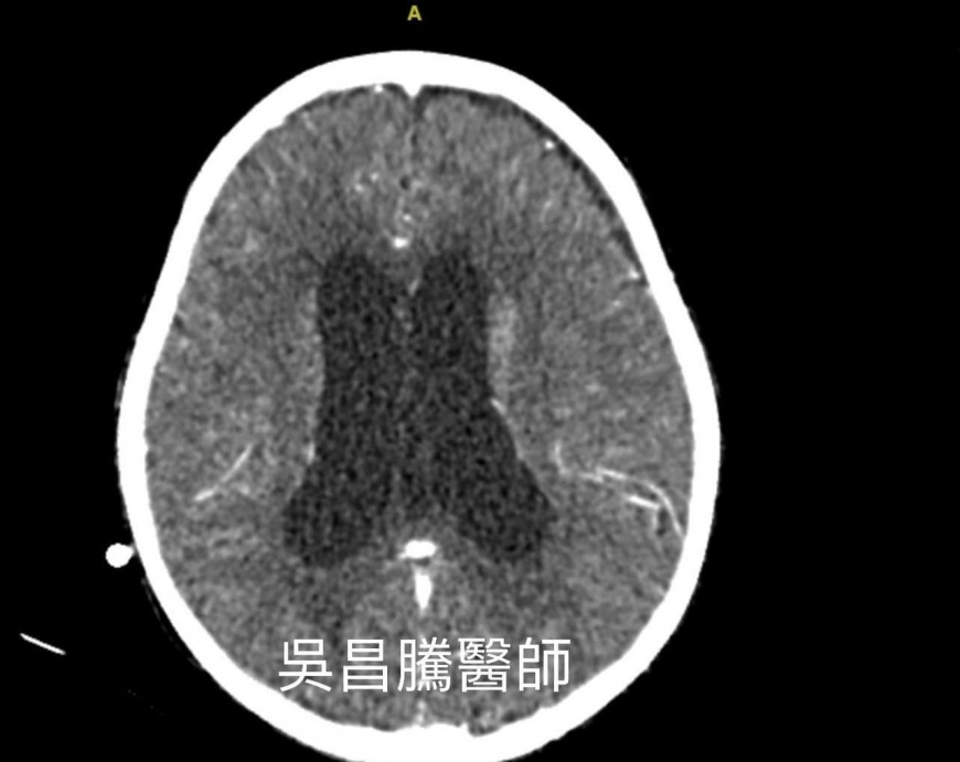 典型的肺炎鏈球菌腦膜炎多有發燒和腦膜炎的症狀。（圖／翻攝自來講兒科急診的543-吳昌騰醫師 臉書）