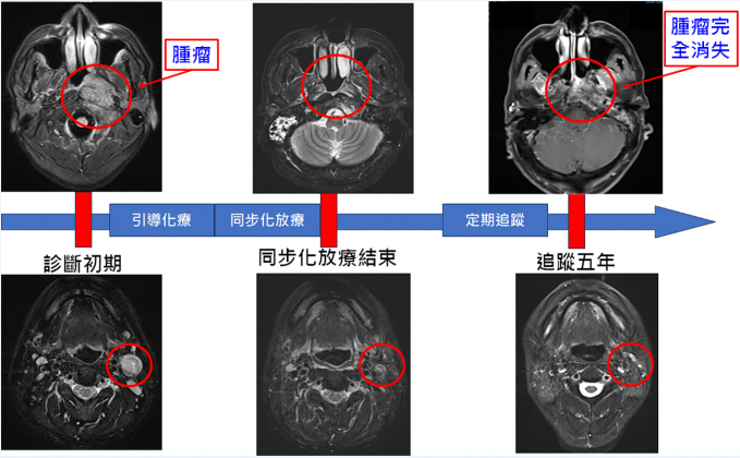 蔡姓男子鼻咽內視鏡檢查結果。（圖／翻攝亞東醫院官網）